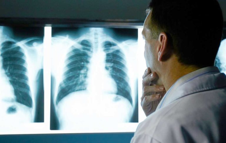 cáncer de pulmón
