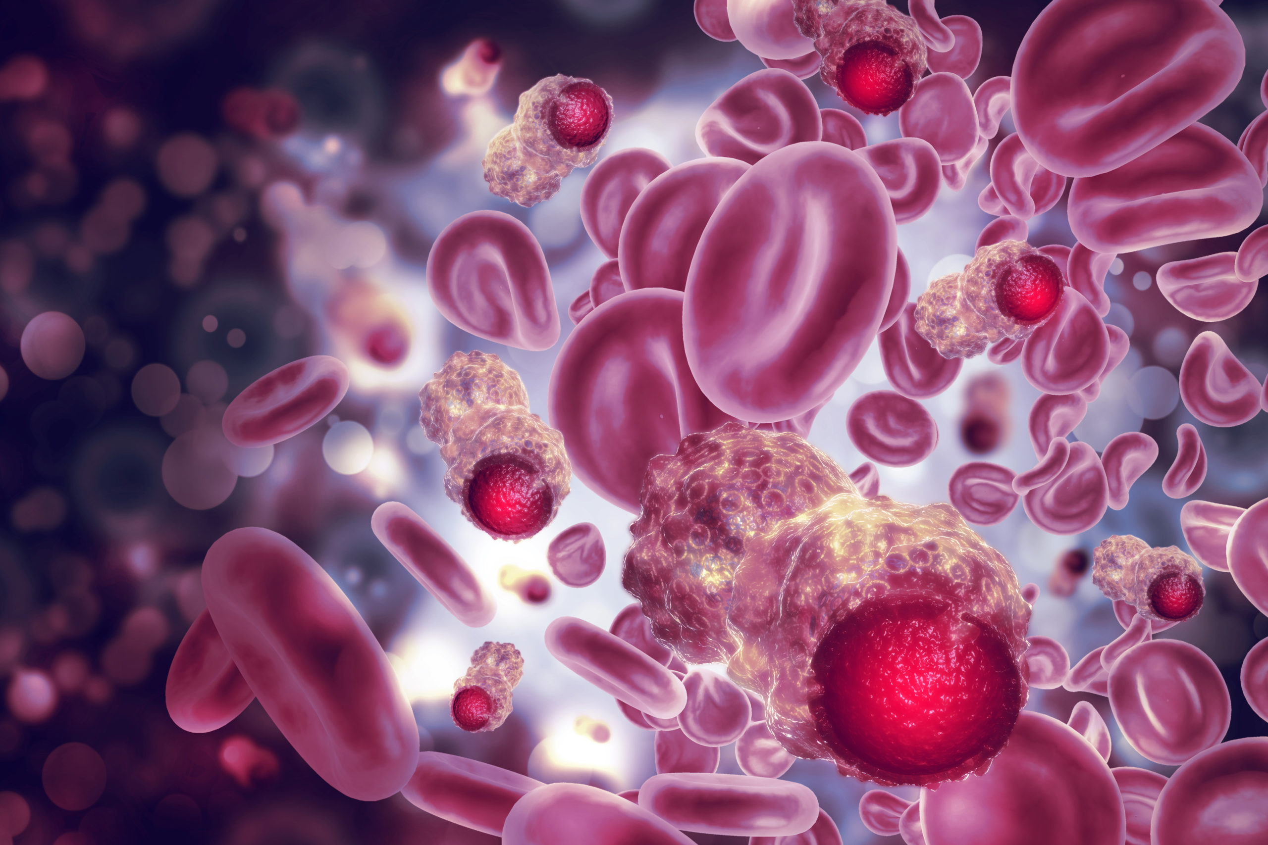 El Mieloma Múltiple es el segundo tipo de cáncer hematológico más frecuente en los mexicanos. Según datos de Globocan, México registra 2,390 casos al año, por lo que nuestro país enfrenta un reto importante sobre la falta de un diagnóstico temprano y oportuno, así como en la demora de atención en el sistema de salud.